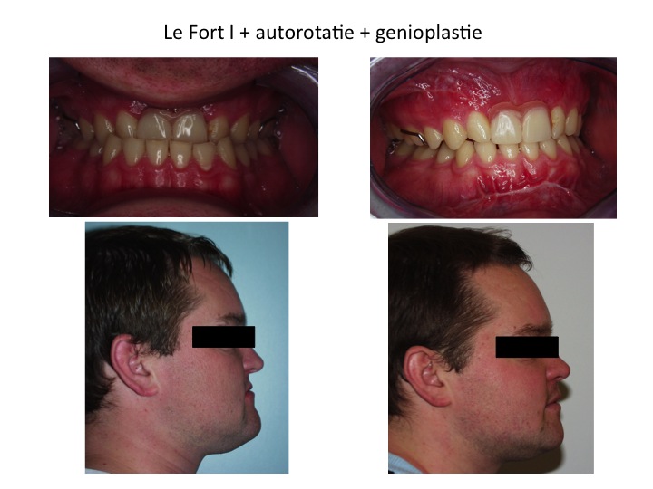 Le Fort I osteotomie + autorotatie mandibula + genioplasie