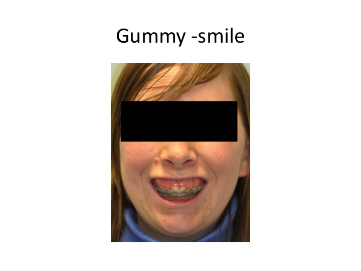 gummy smile