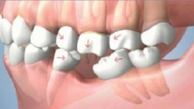 Krachtig Dankzegging niet Vervanging van één enkele tand | MKA centrum